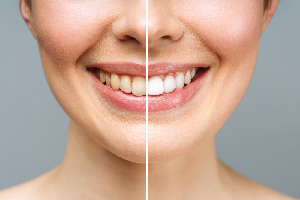 Achieve a Dazzling Smile: 5 Tips for Whiter Teeth